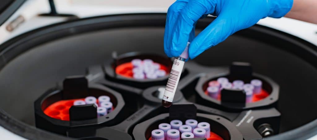 A doctor holds a vial of plasma before putting it in a centrifuge