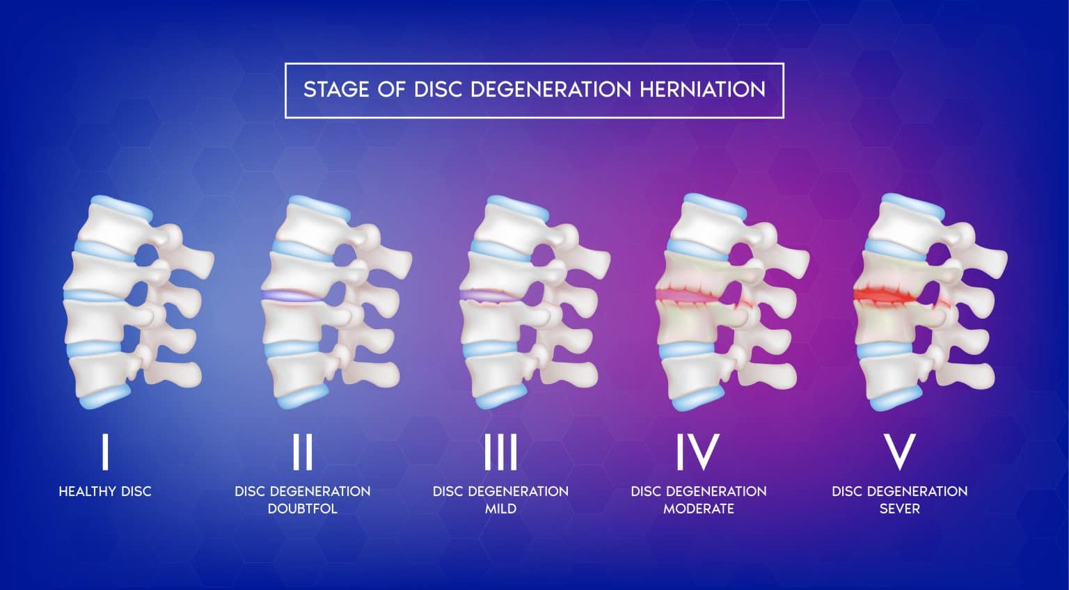 Stages Of Degenerative Disc Disease