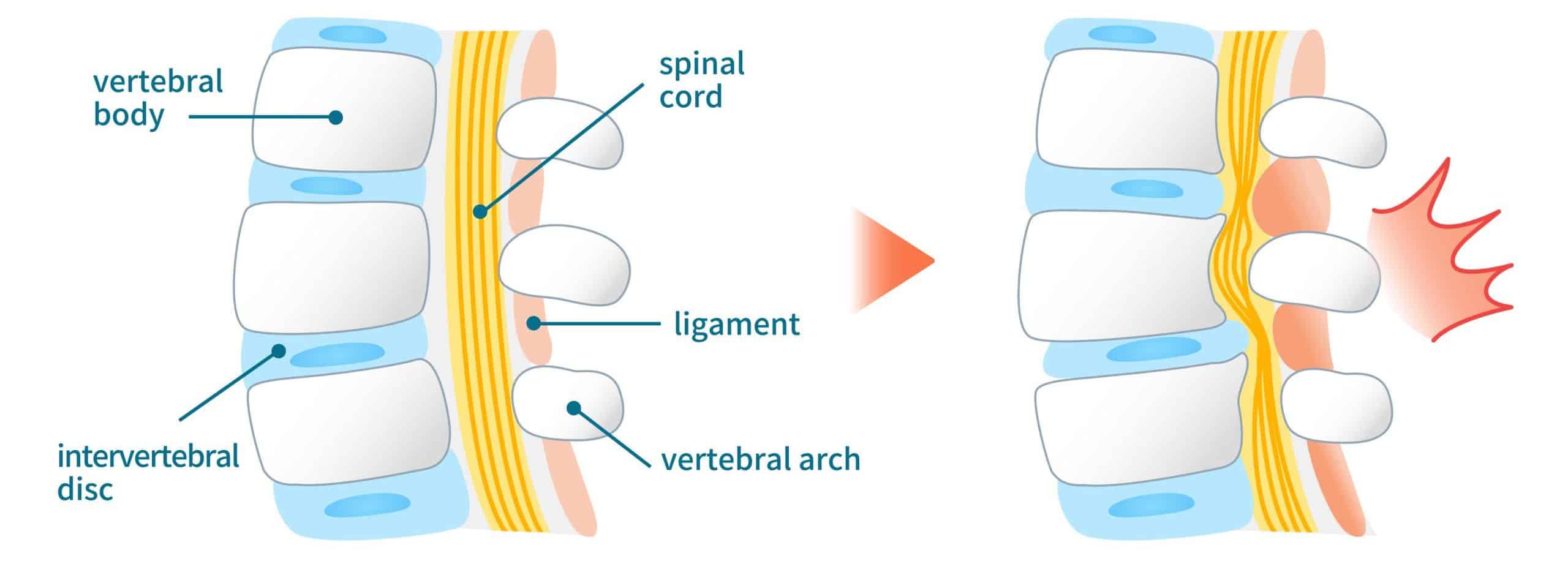 Illustration of lumbar spinal canal stenosis Illustration of lumbar spinal canal stenosis