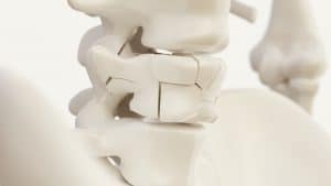 Vertebral fracture due to osteoporosis of the spine - 3d rendering