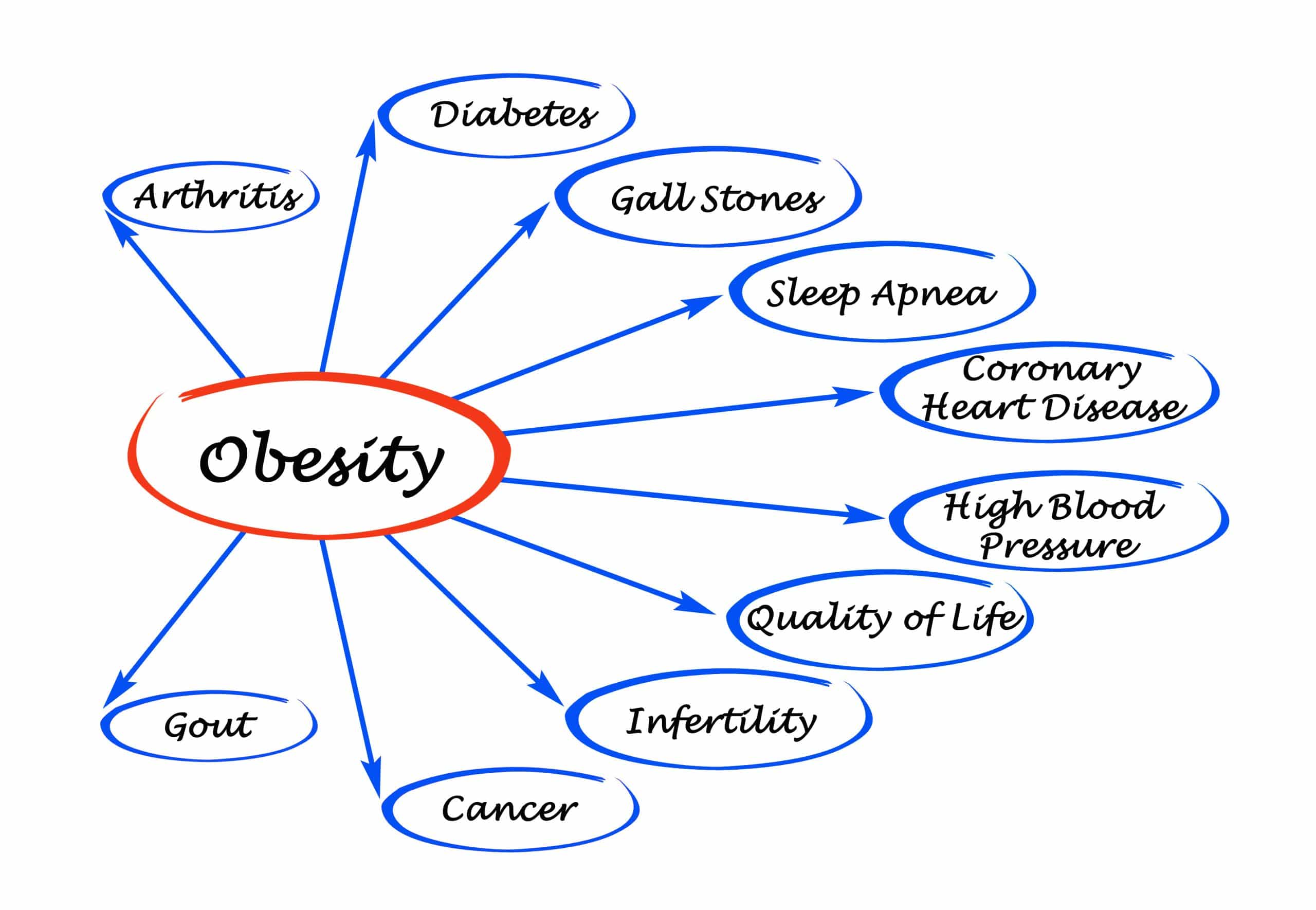 Diagram of Obesity Diagram with the effects of Obesity on the body.