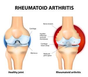 Normal Joint and Rheumatoid Arthritis infographic