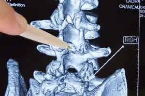 Epidural steroid injection procedure for back pain relief
