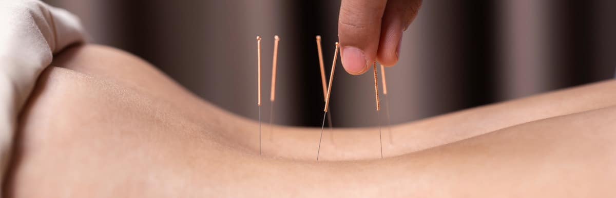 Heart Disease Symptoms You Need to Know (11) Acupuncture needles are placed in a patient's back for middle back pain relief