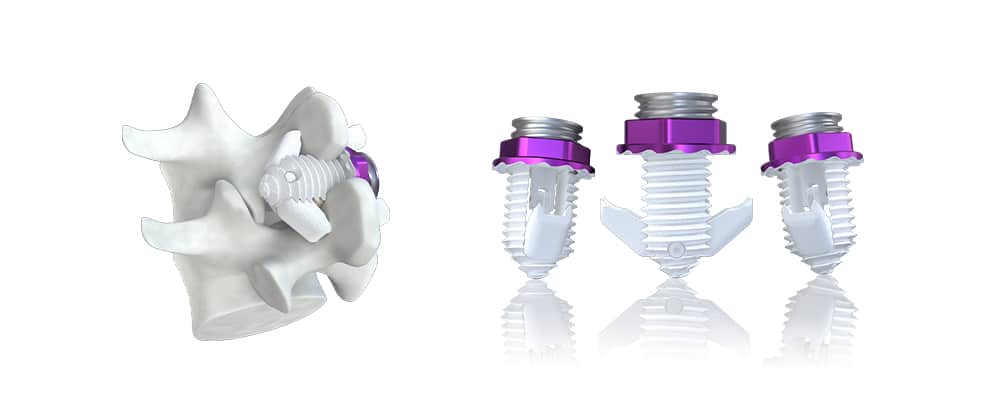 Minuteman-Spinal-Simplicity Spinal Simplicity's Minuteman® interspinous-interlaminar fusion device