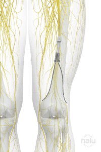 A human leg with nerves running through it