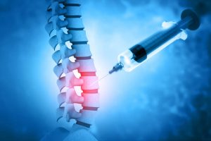 Needle injecting a spine to symbolized radio frequency ablation