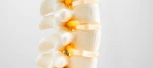 A spine model showing herniated discs