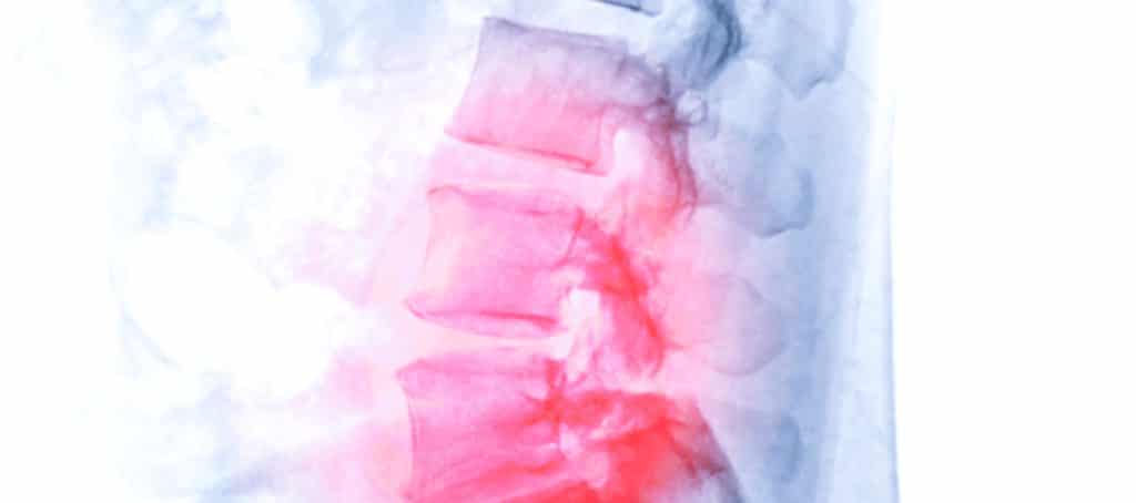 A spine xray with a red highlight showing degenerative disc disease.