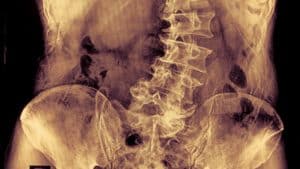 scoliosis